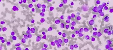 leukaemia under the microscope